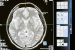 ChatGPT’s AI diagnoses brain tumors with unprecedented accuracy, study reveals